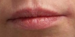 Lip Enhancement with Restylane Silk. 