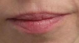 Before Lip Enhancement