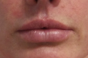 Restylane Silk, Dr. Weiner