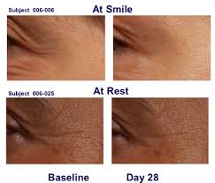Revance topical treatment, RT001