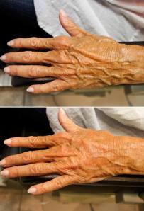 Before and after hand volumization with Radiesse.  