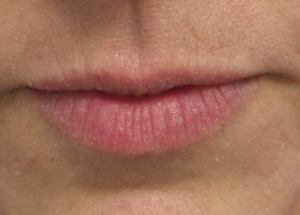 Dr. Weiner performing Lip Enhancement with Restylane Silk