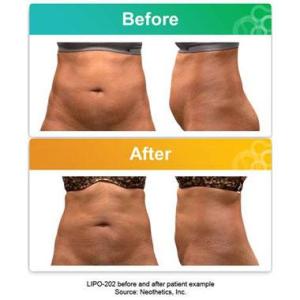 Lipo 202 for abdomenal fat reduction with injections.